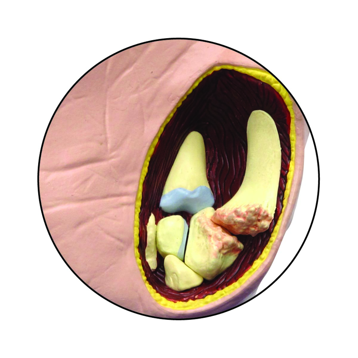 Modelo de mano con osteoartritis Código: TB1019520 - Imagen 3