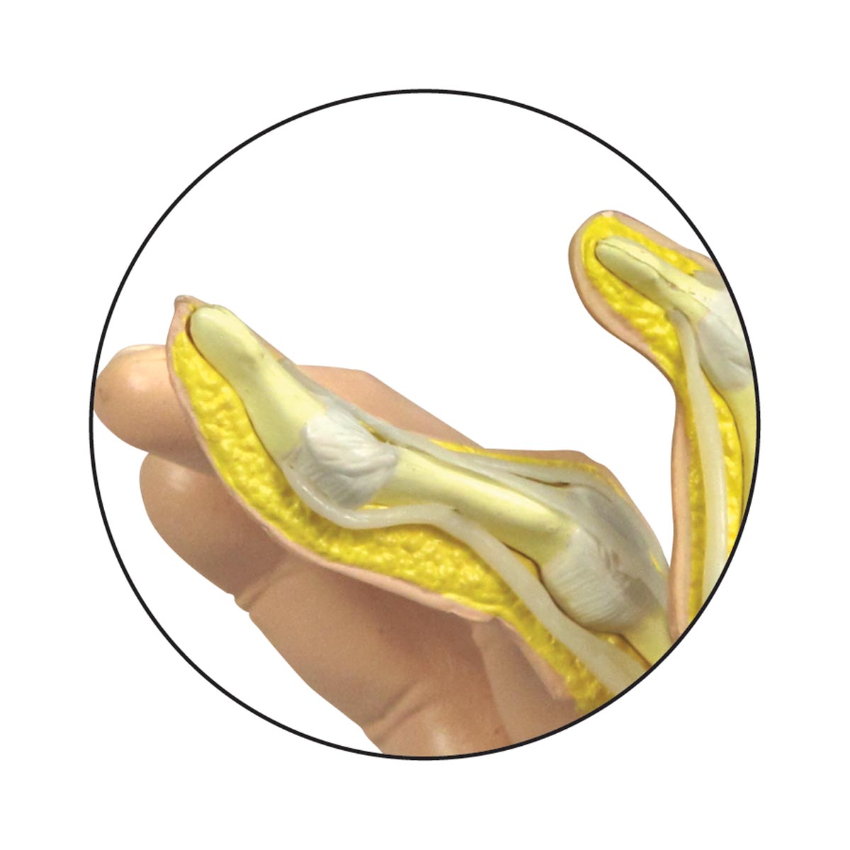 Modelo de mano con artritis reumatoide Código: TB1019521 - Imagen 3